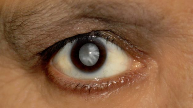 https://www.fabriciowitzel.com.br/wp-content/uploads/2014/05/Cataract_patient-628x353.jpg