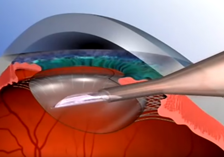 Conheça os tipos de lentes intra oculares para catarata Lentes e Óculos Viallure